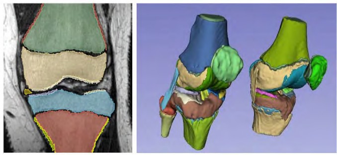 3D knee geometries created from existing pediatric knee MRI using the developed framework